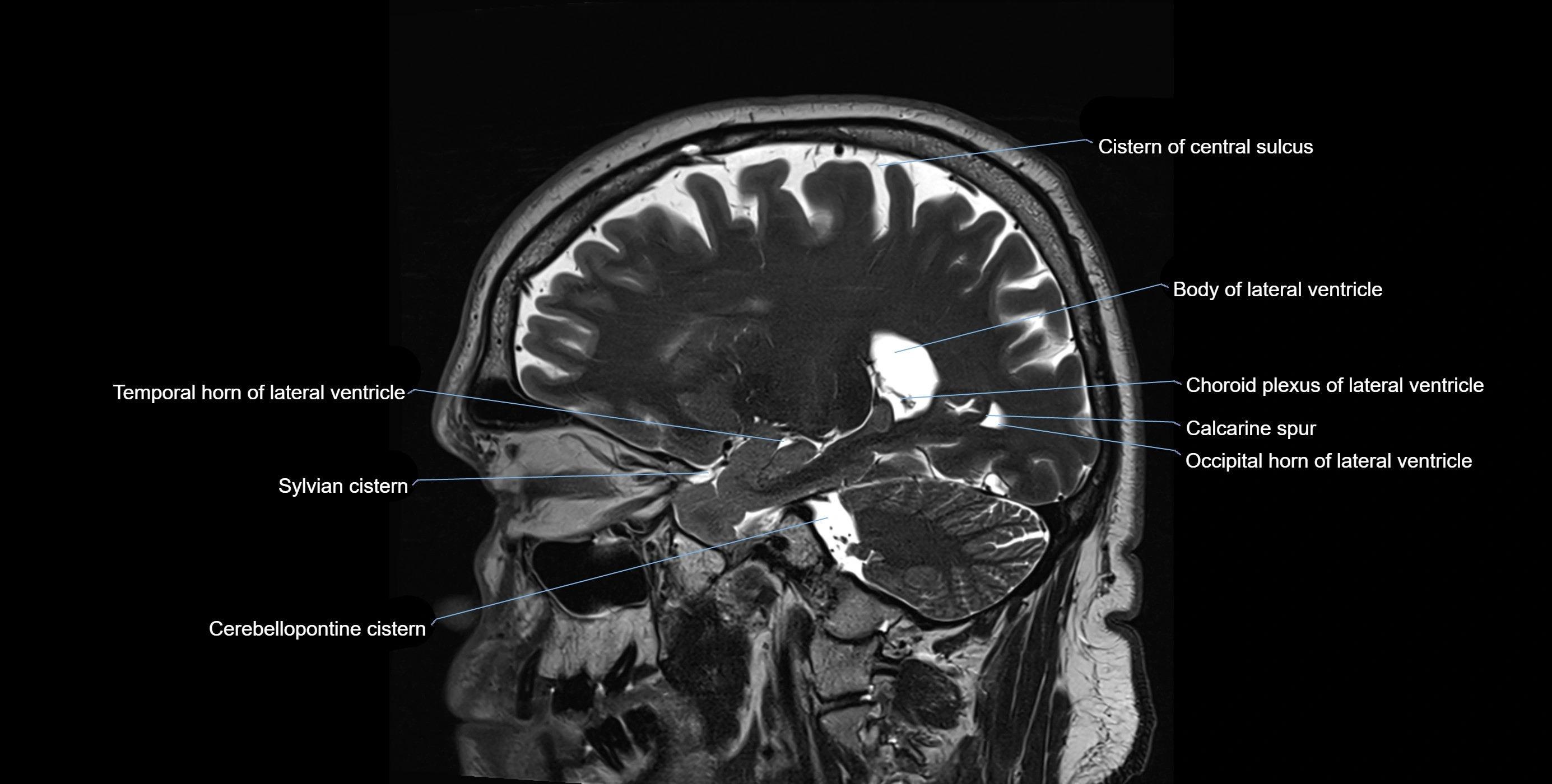 Brain cisterns  and ventricles sagittal anatomy 3T MRI image-img-00001-00019.webp